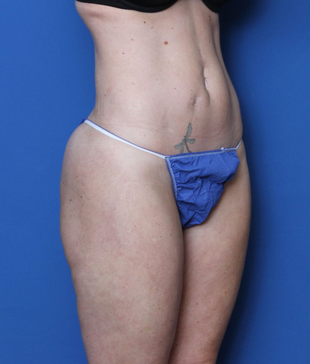 Liposuction Patient Photo - Case 156 - after view-1