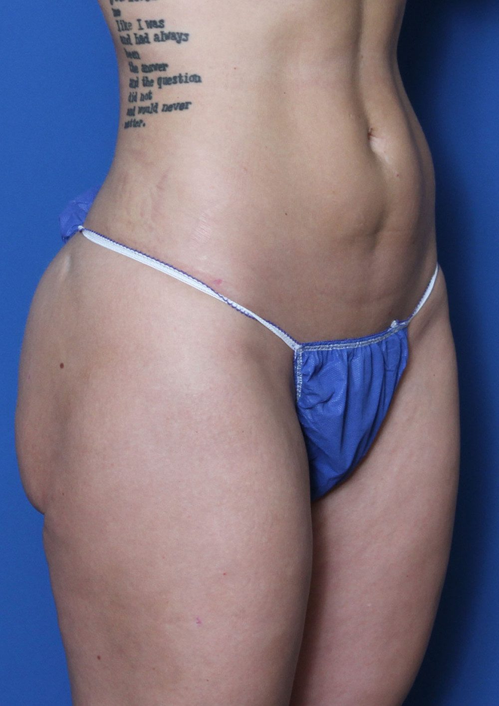 Liposuction Patient Photo - Case 158 - after view-1