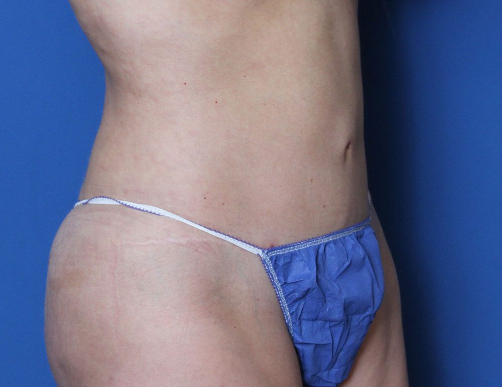 Liposuction Patient Photo - Case 160 - after view-1
