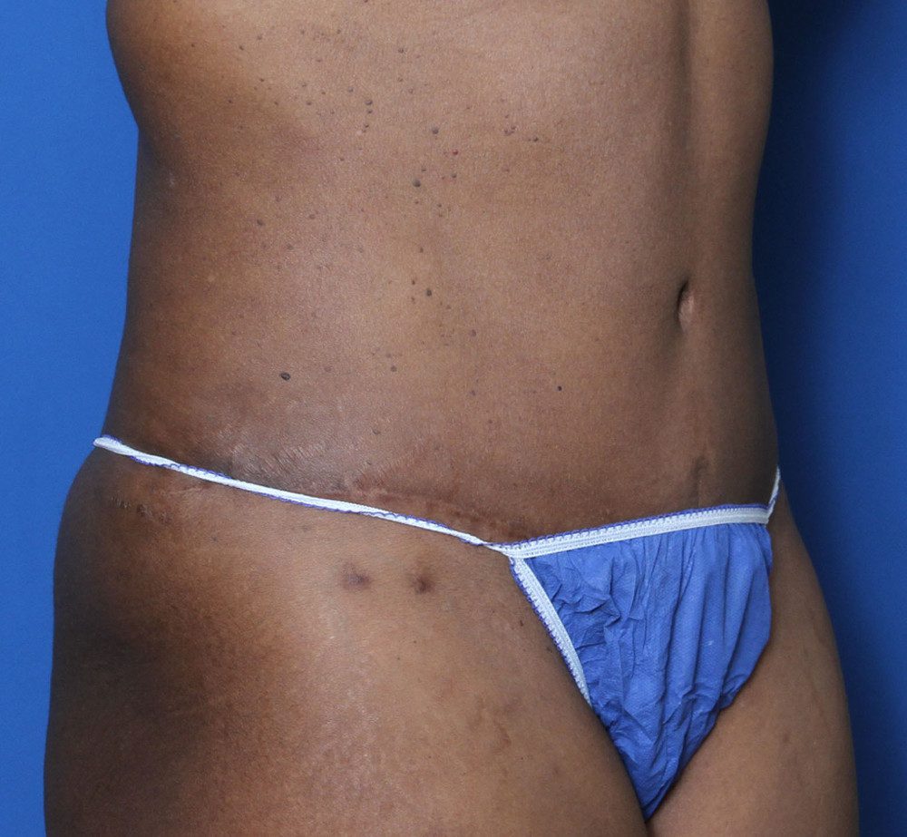 Tummy Tuck Patient Photo - Case 134 - after view-1