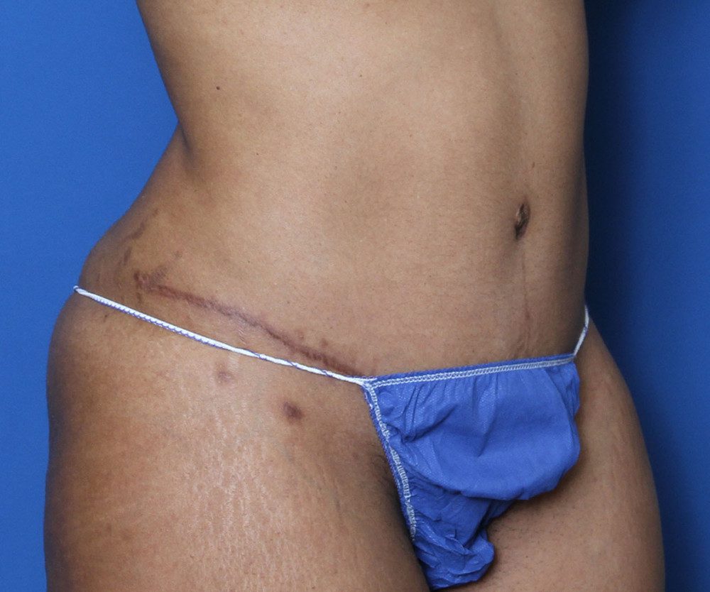 Tummy Tuck Patient Photo - Case 135 - after view-1