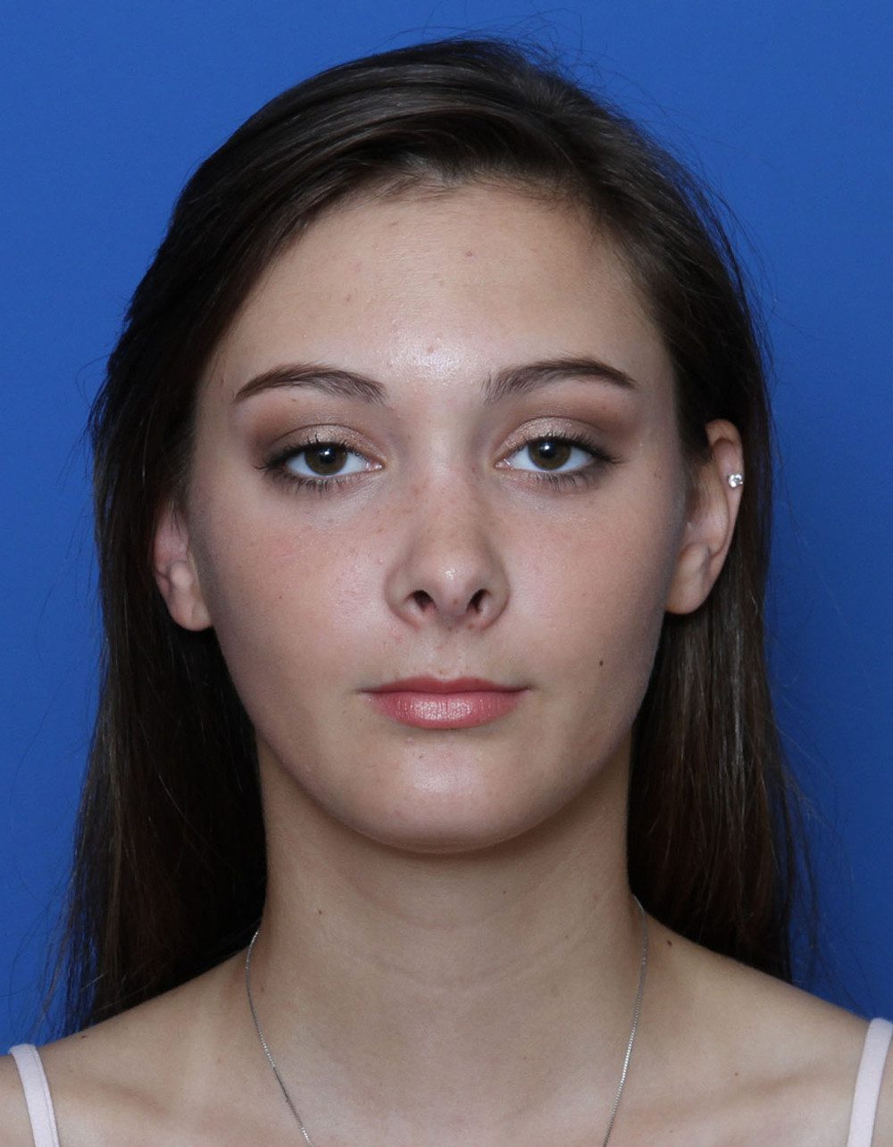 Rhinoplasty Patient Photo - Case 172 - after view