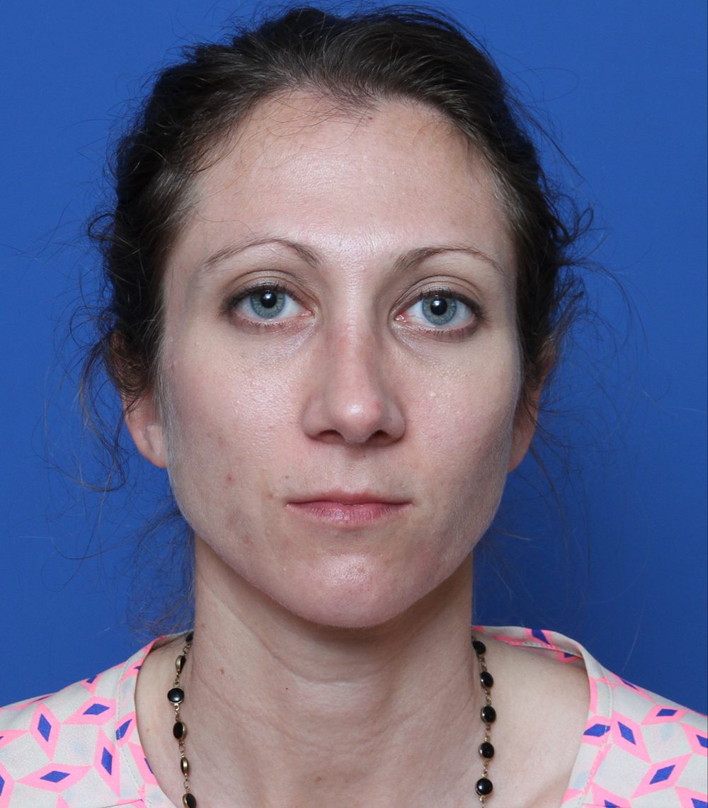 Rhinoplasty Patient Photo - Case 176 - after view-0