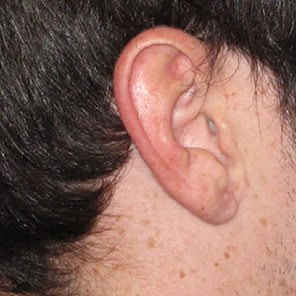Ear Surgery Patient Photo - Case 178 - after view-0