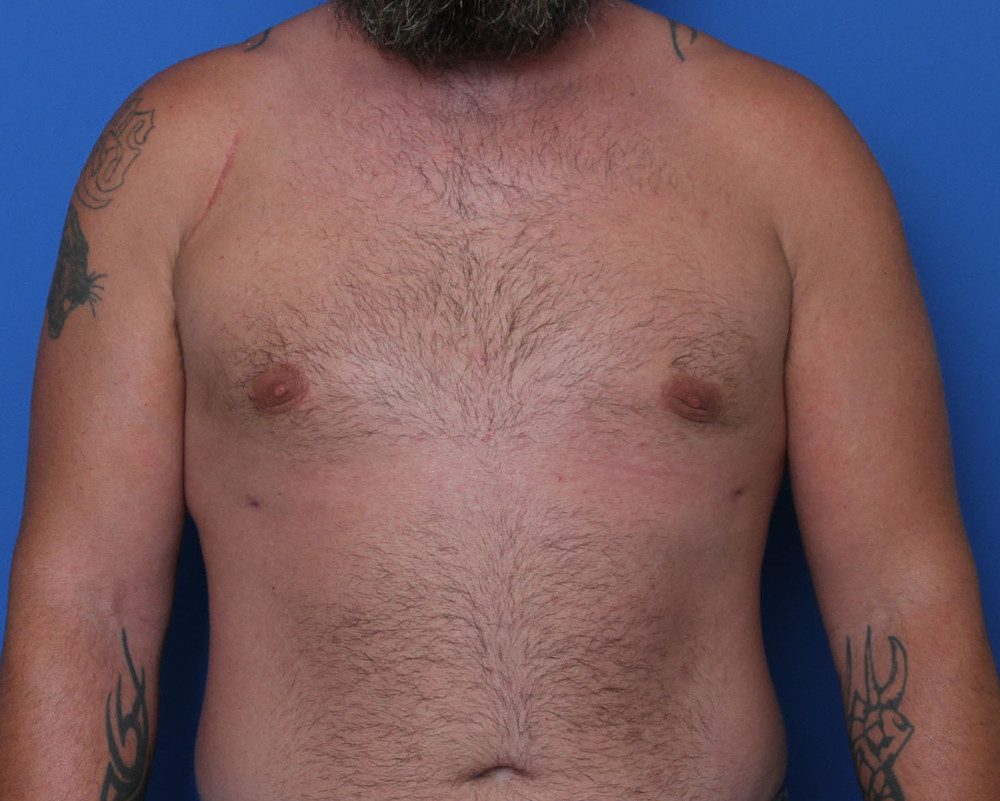 Gynecomastia Patient Photo - Case 188 - after view