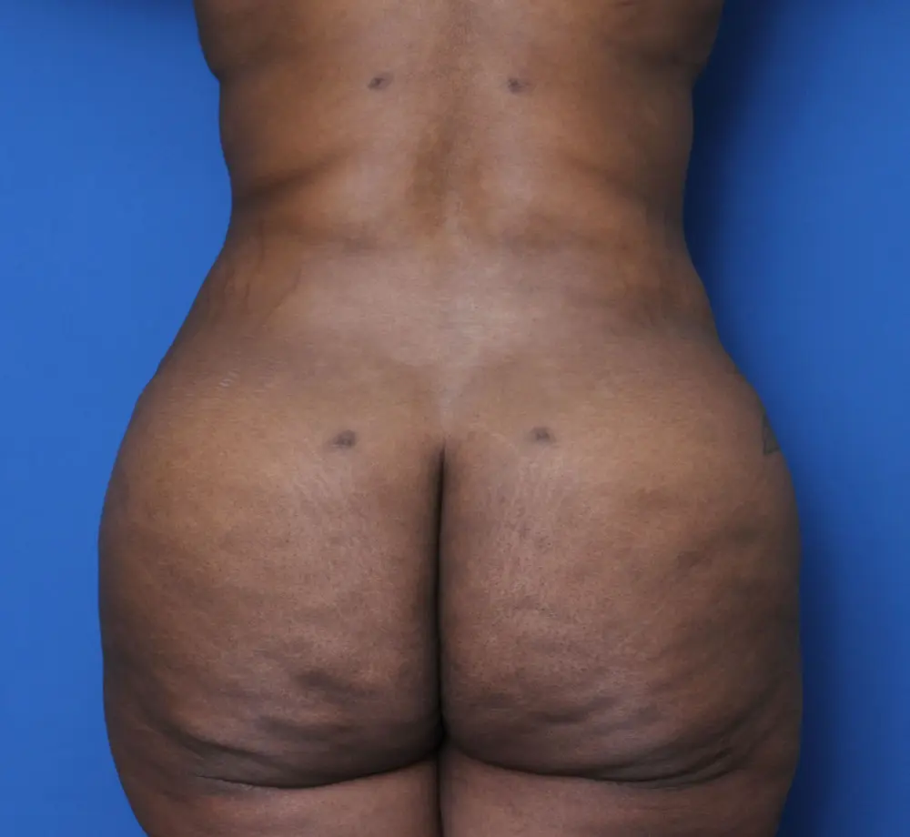 BBL/Butt Lift Patient Photo - Case 148 - after view