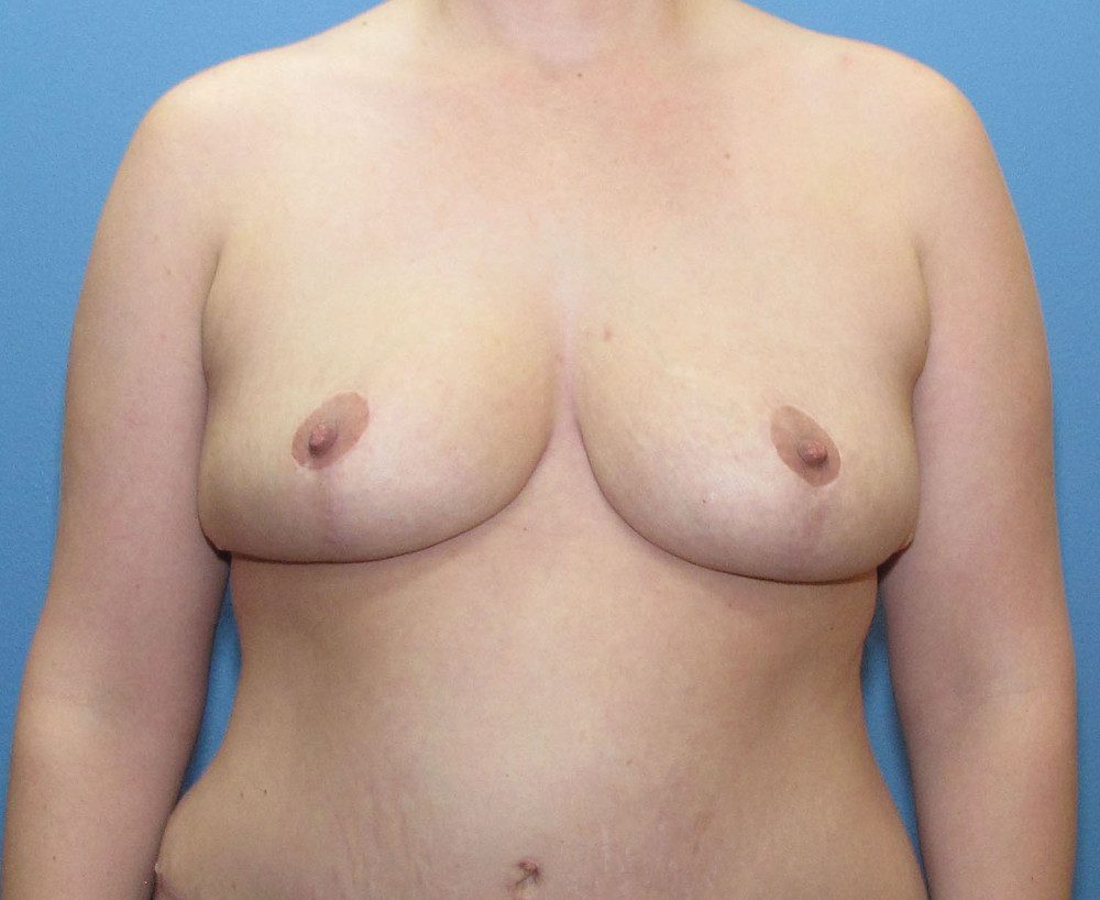 Breast Lift Patient Photo - Case 198 - after view