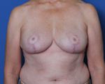 Breast Lift - Case 199 - After