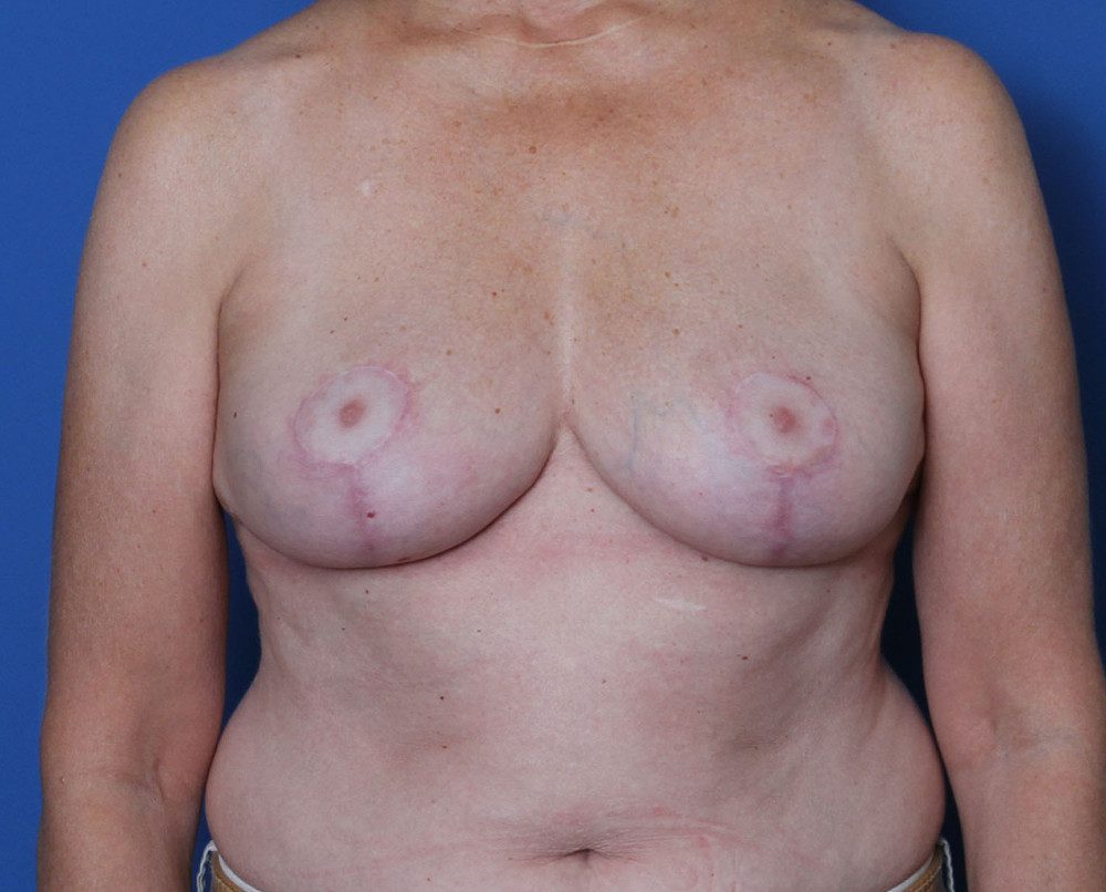 Breast Lift Patient Photo - Case 199 - after view