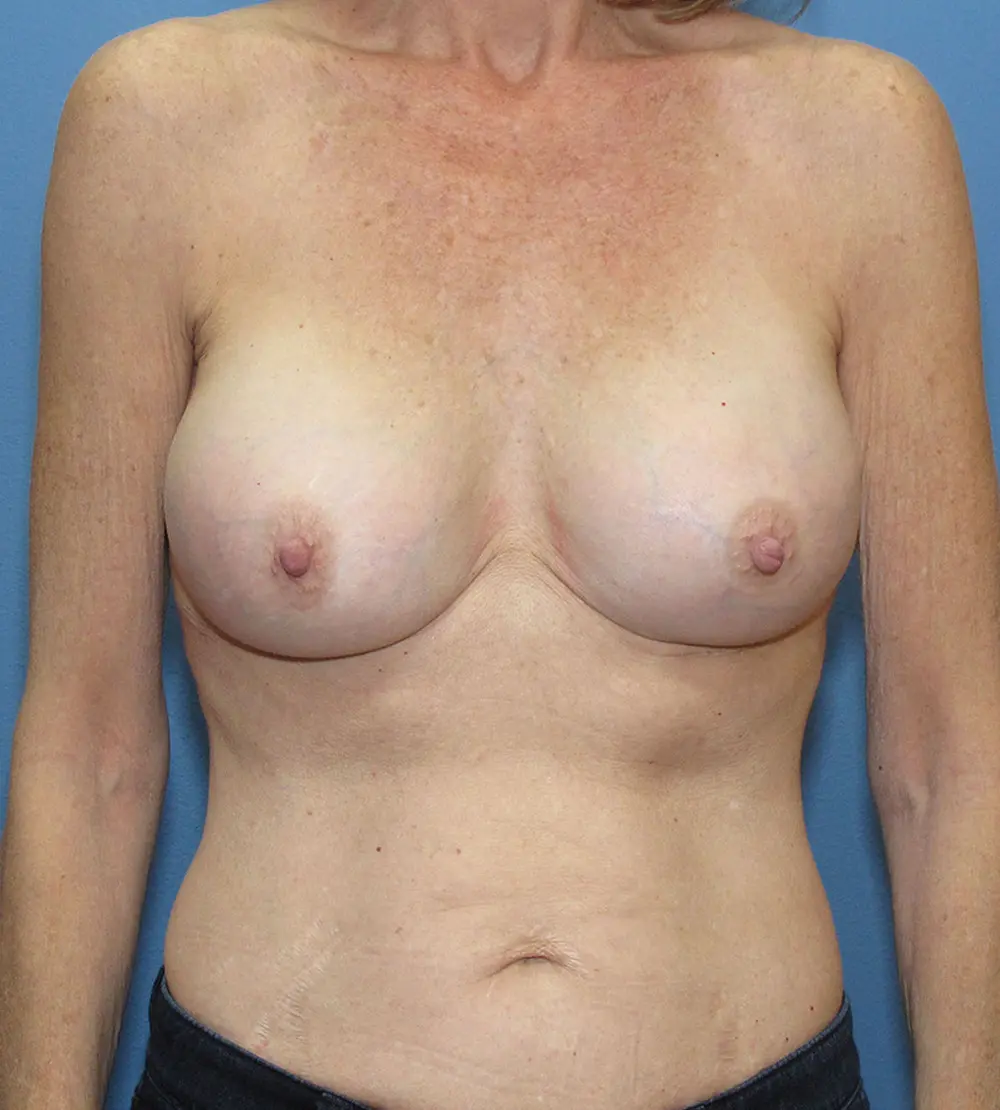 Breast Revision Patient Photo - Case 213 - after view-0