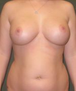 Breast Revision - Case 214 - After