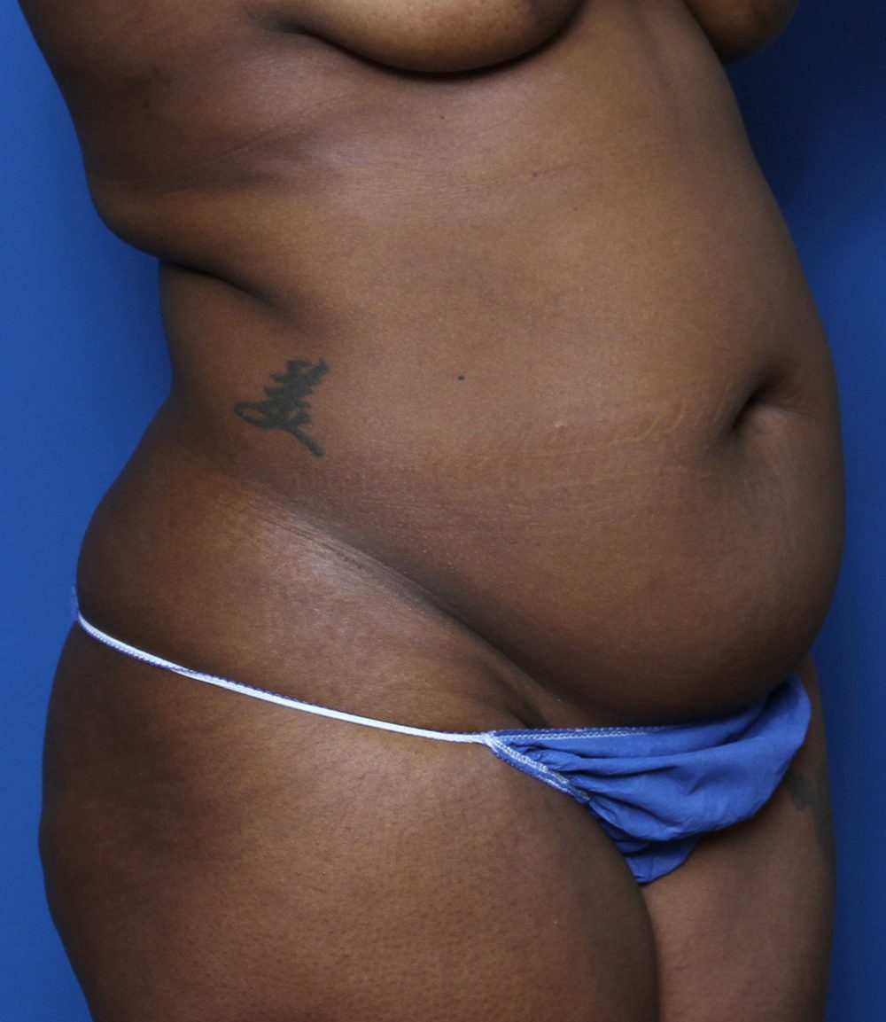 Tummy Tuck Patient Photo - Case 132 - before view-1