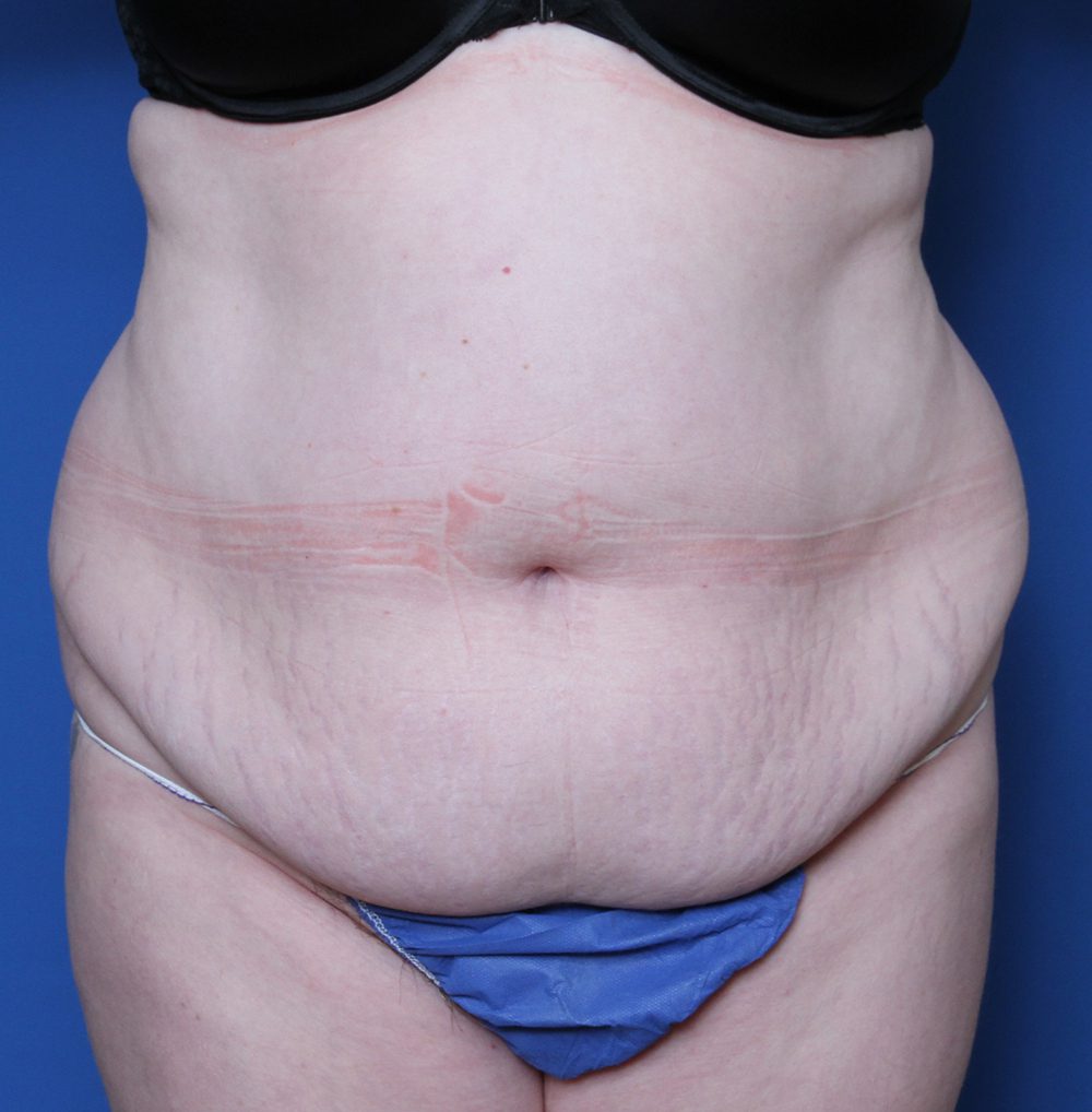 Belt Lipectomy Patient Photo - Case 142 - before view-