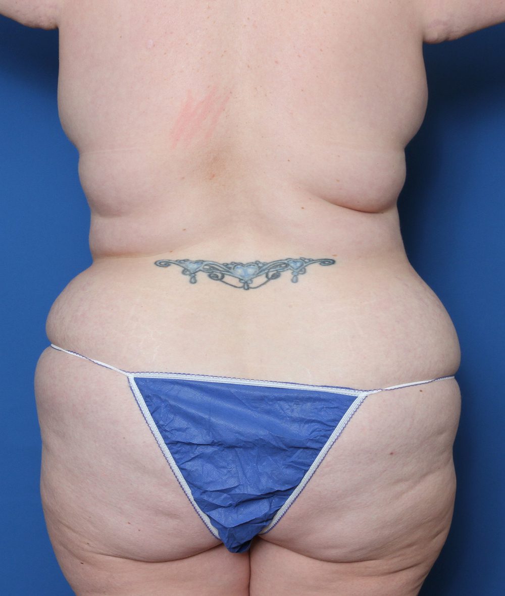 Belt Lipectomy Patient Photo - Case 143 - before view-2