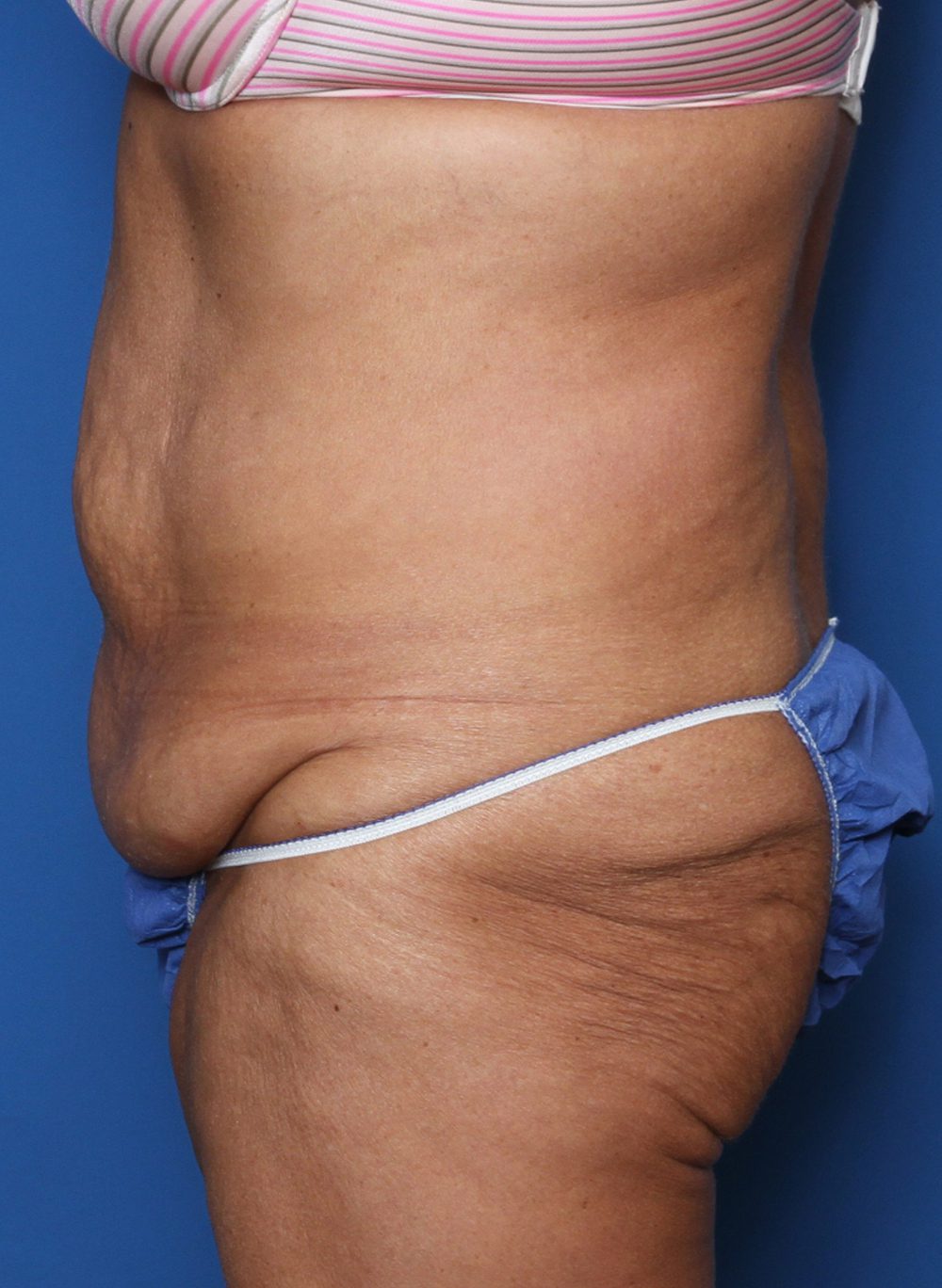 Belt Lipectomy Patient Photo - Case 144 - before view-1