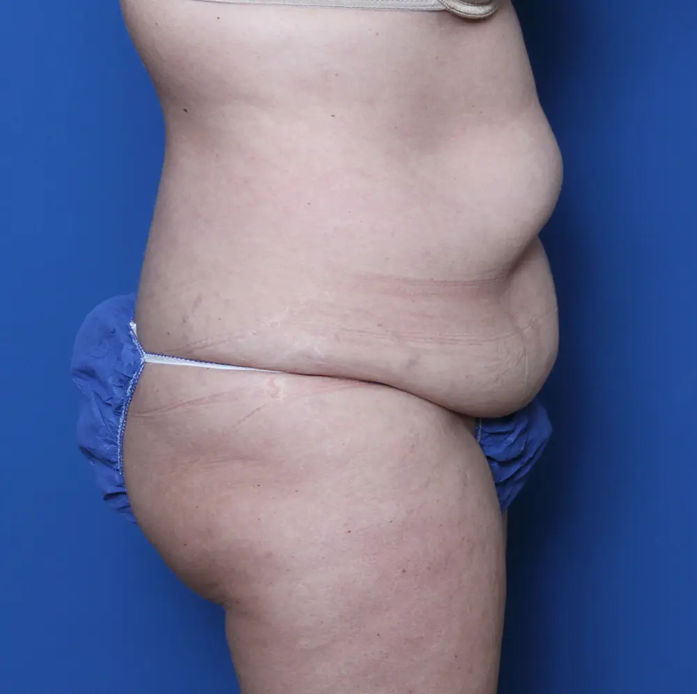 Belt Lipectomy Patient Photo - Case 145 - before view-2