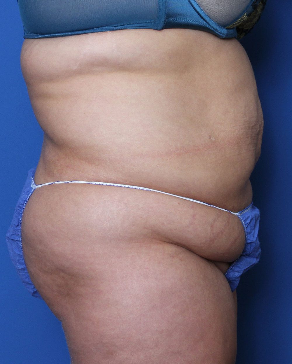 Belt Lipectomy Patient Photo - Case 146 - before view-2