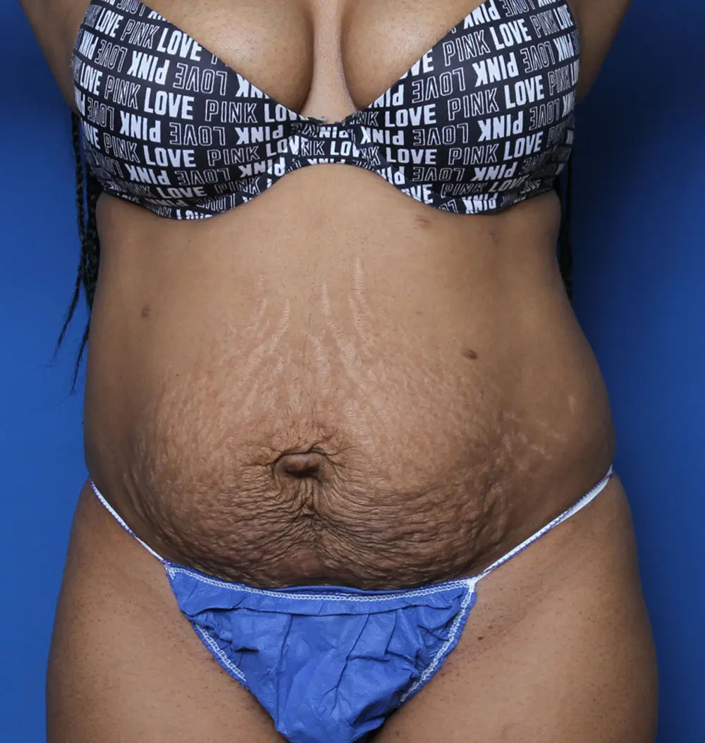 Tummy Tuck Patient Photo - Case 133 - before view-0