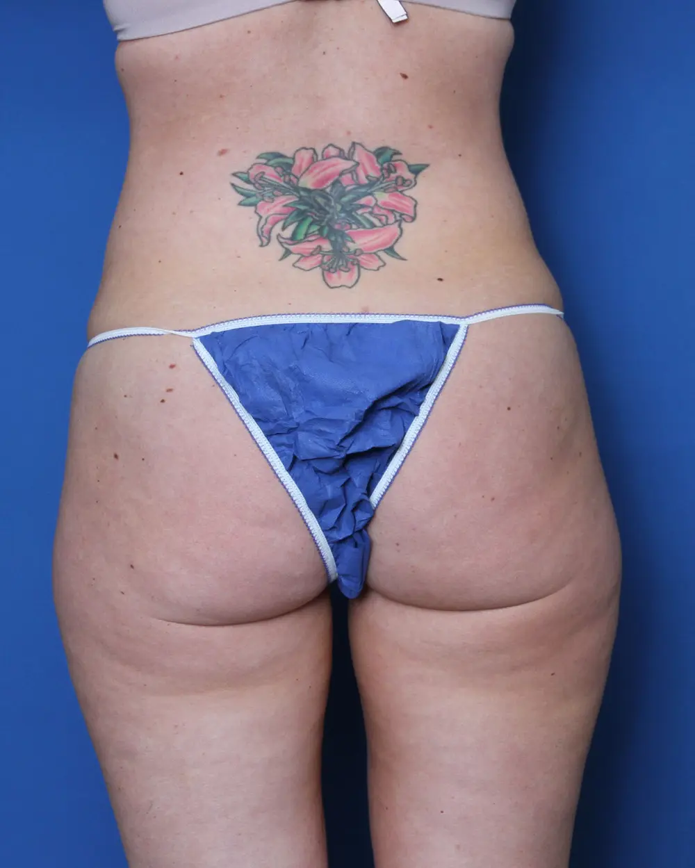 Liposuction Patient Photo - Case 156 - before view-