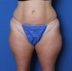 Liposuction - Case 157 - Before