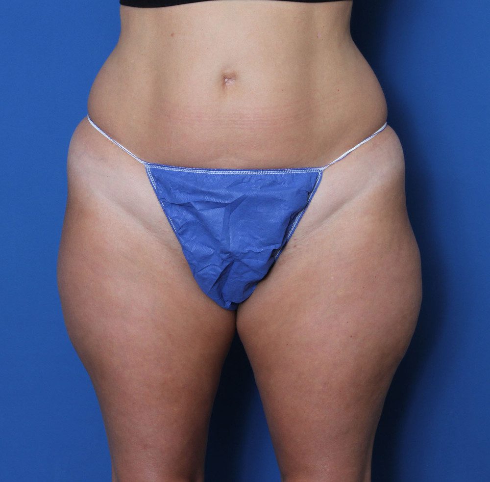 Liposuction Patient Photo - Case 157 - before view-0