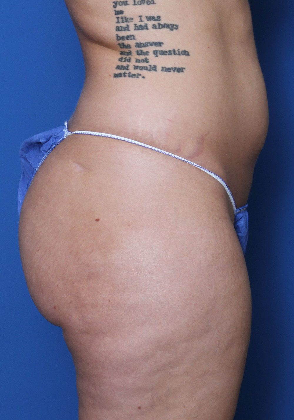 Liposuction Patient Photo - Case 158 - before view-2