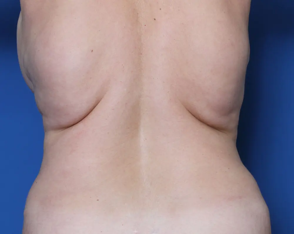 Liposuction Patient Photo - Case 160 - before view-