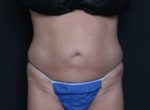 CoolSculpting - Case 161 - Before