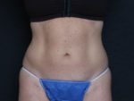 CoolSculpting - Case 163 - Before