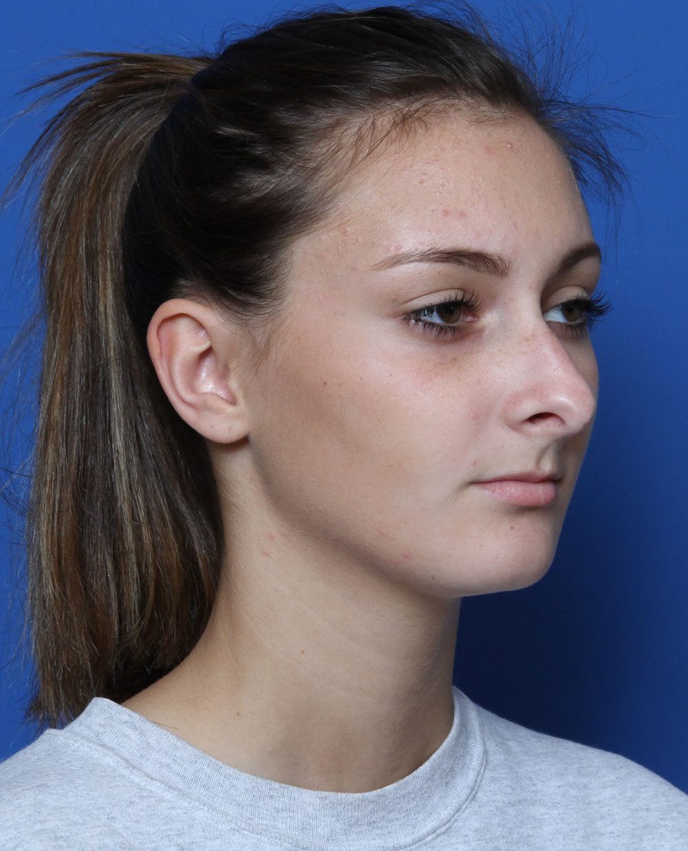 Rhinoplasty Patient Photo - Case 172 - before view-1