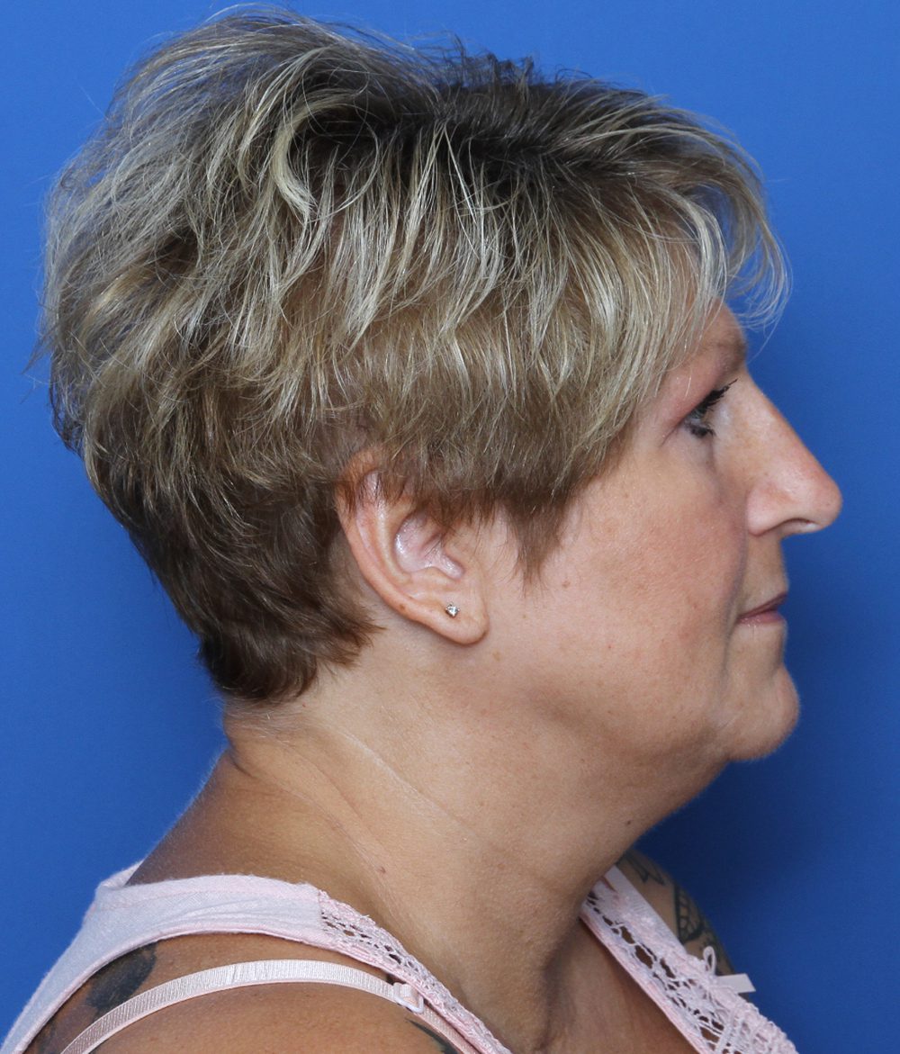 Rhinoplasty Patient Photo - Case 173 - before view-1