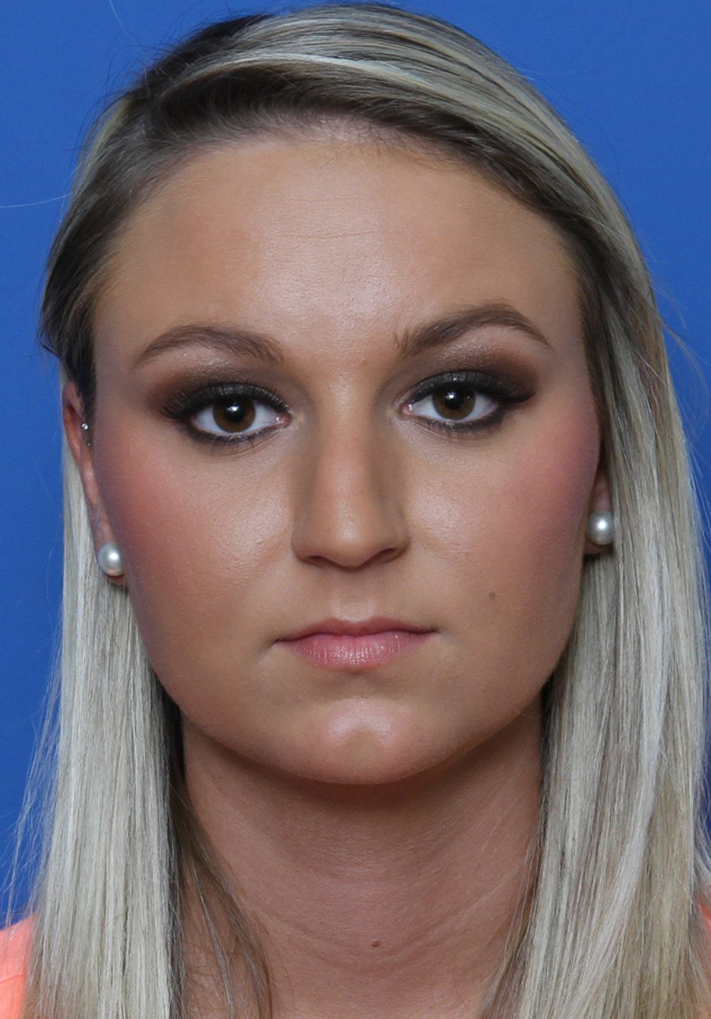 Rhinoplasty Patient Photo - Case 175 - before view-