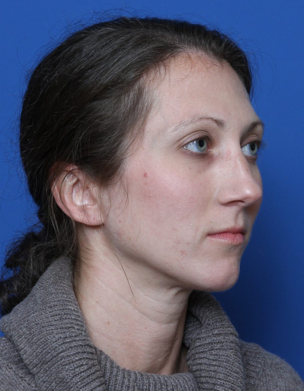 Rhinoplasty Patient Photo - Case 176 - before view-1
