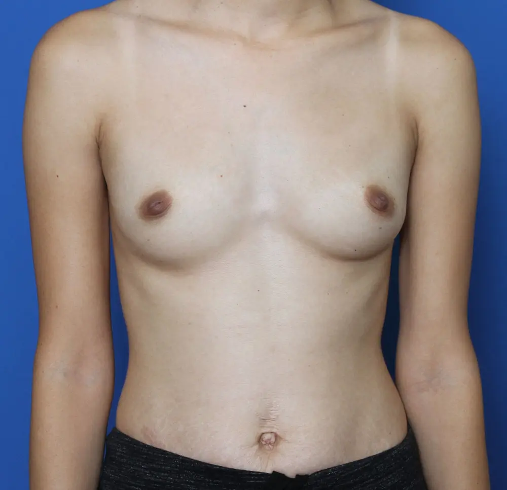 Breast Augmentation Patient Photo - Case 194 - before view-