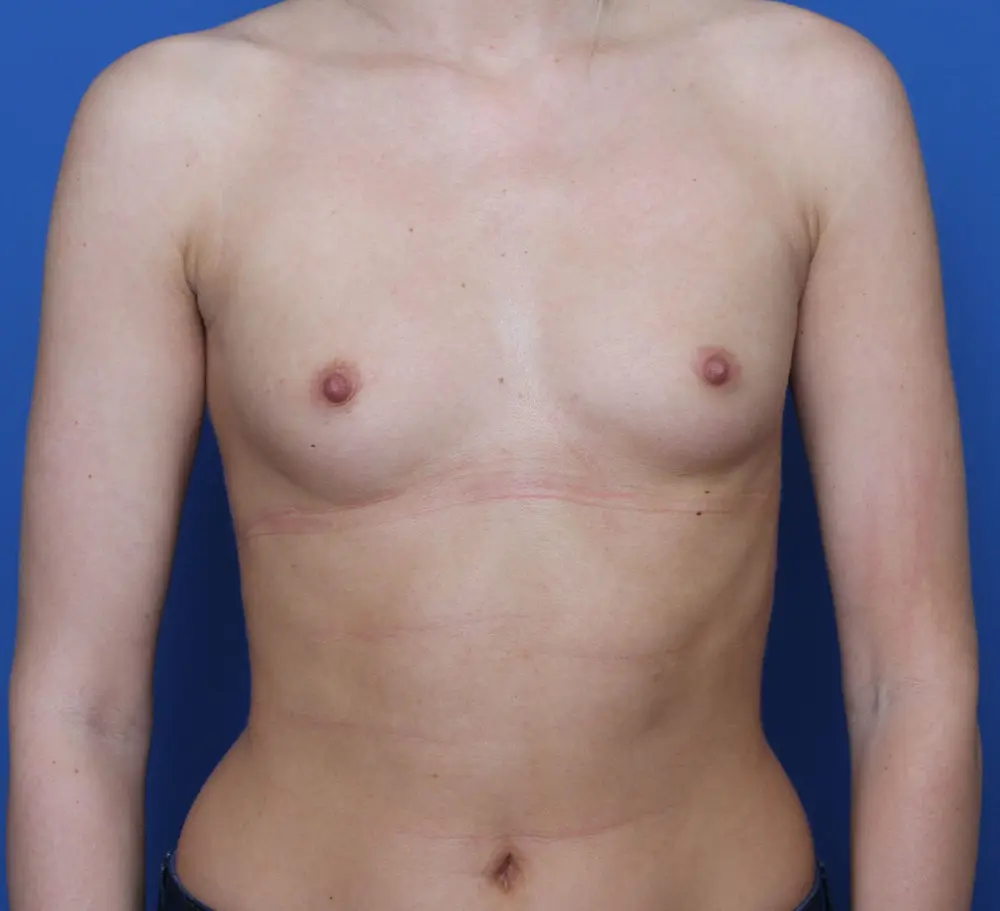 Breast Augmentation Patient Photo - Case 195 - before view-0