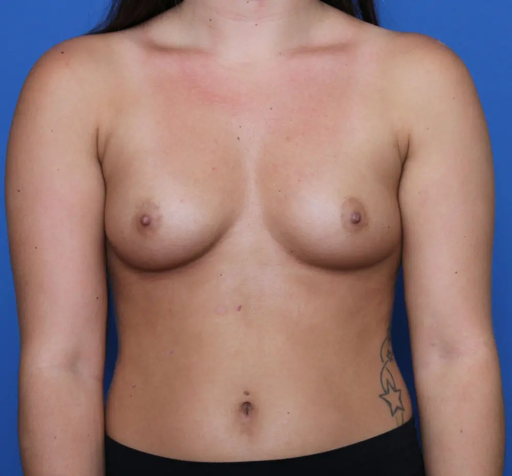 Breast Augmentation Patient Photo - Case 197 - before view-0