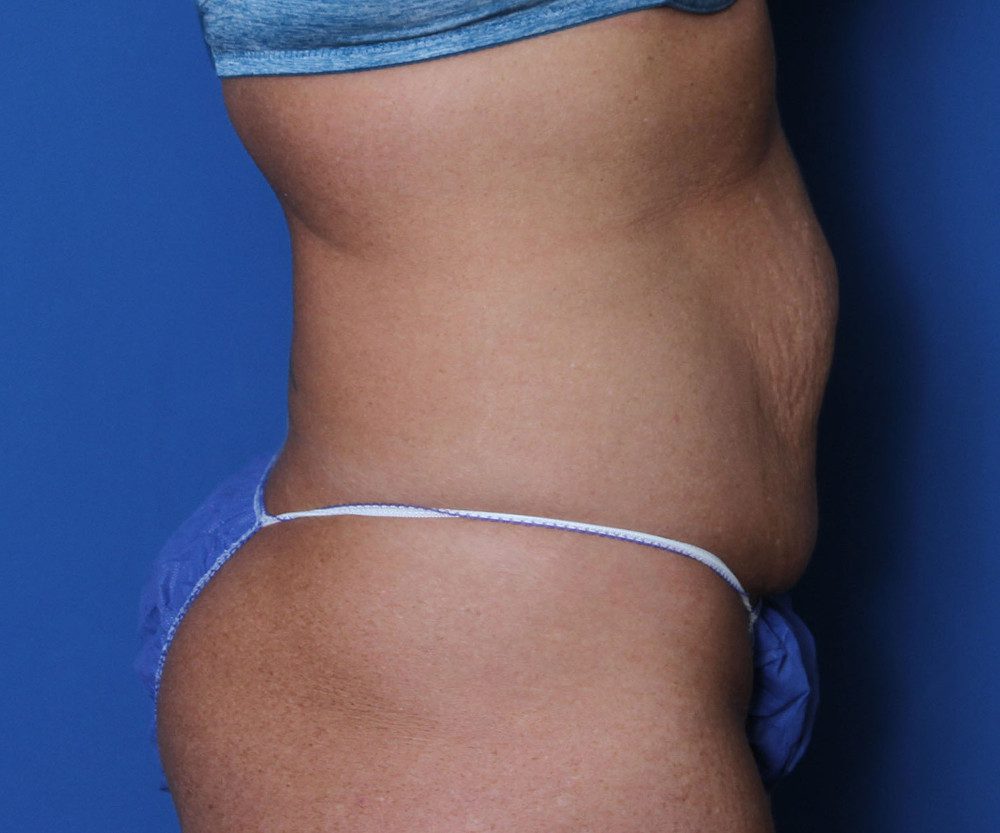 Tummy Tuck Patient Photo - Case 137 - before view-2