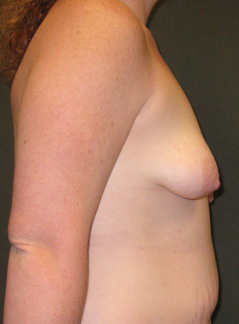 Breast Augmentation/Lift Patient Photo - Case 206 - before view-1