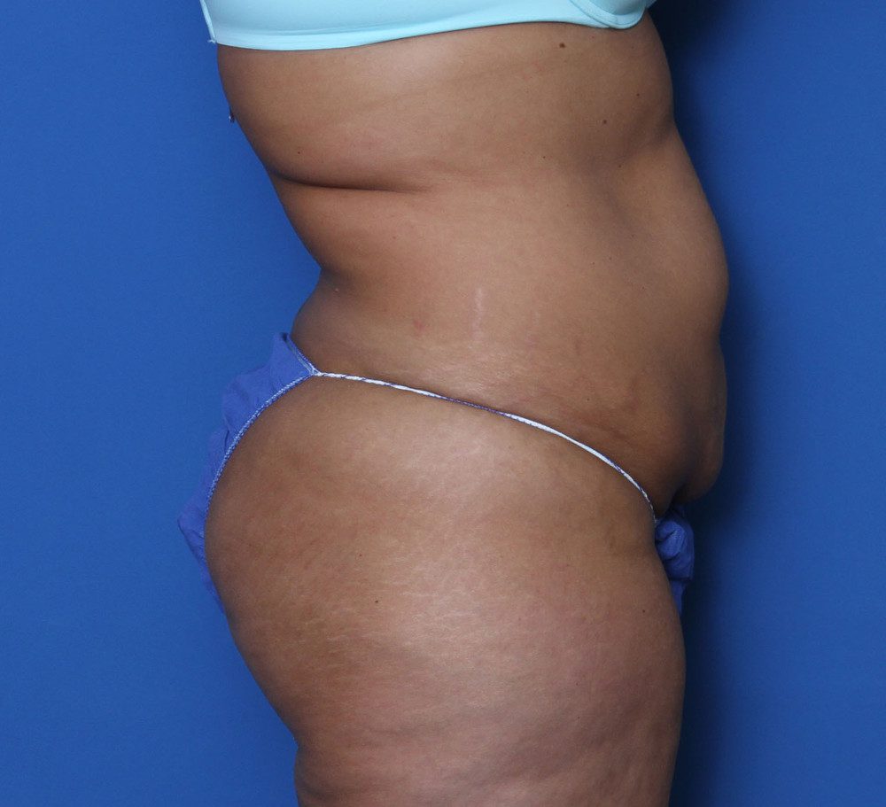 Tummy Tuck Patient Photo - Case 138 - before view-2