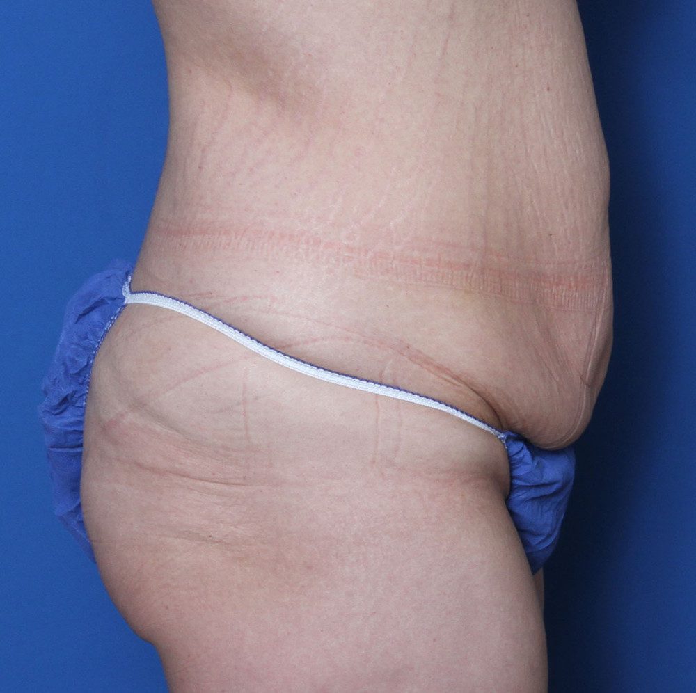 Belt Lipectomy Patient Photo - Case 140 - before view-2
