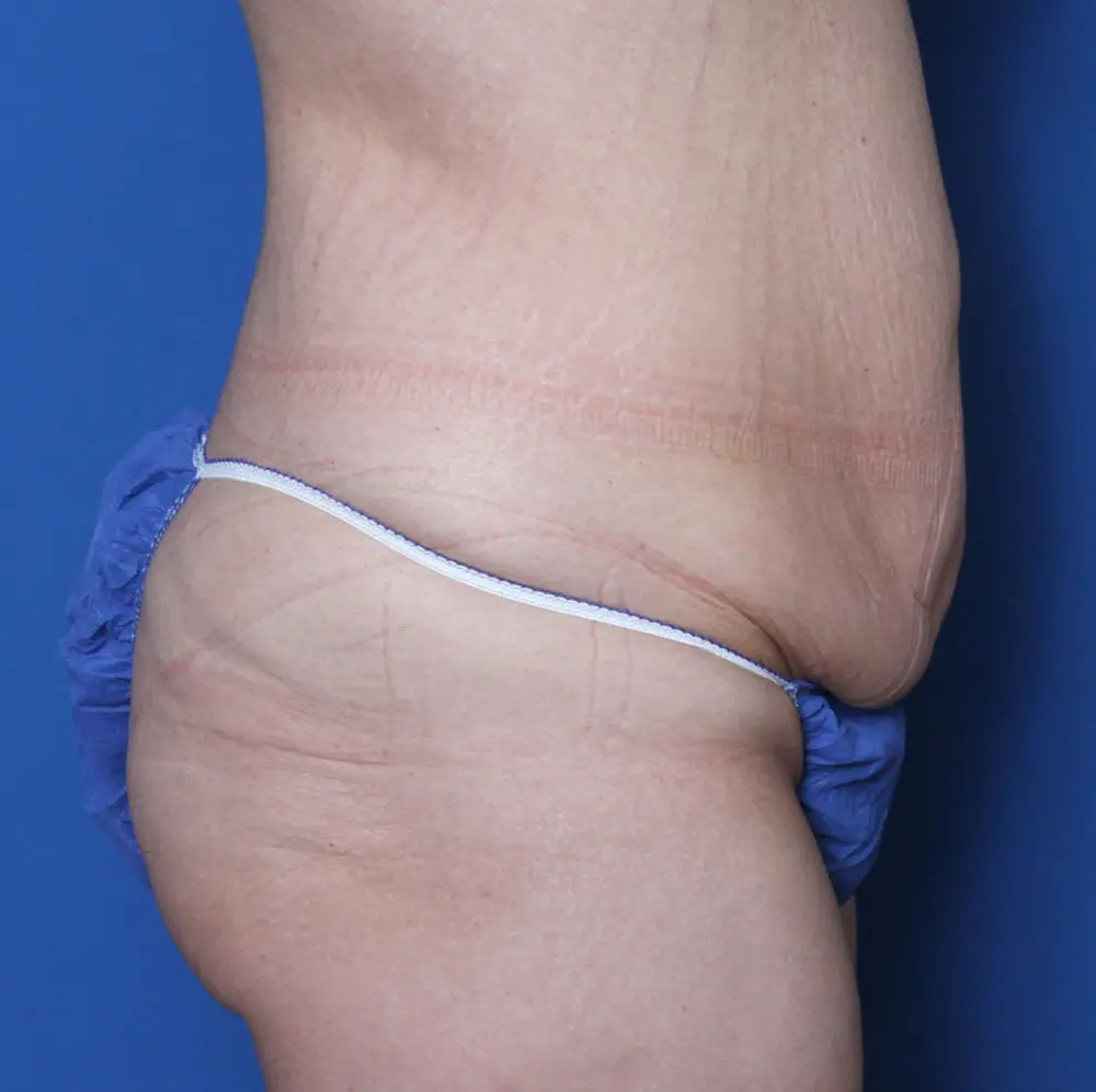 After Weight Loss Patient Photo - Case 140 - before view-2