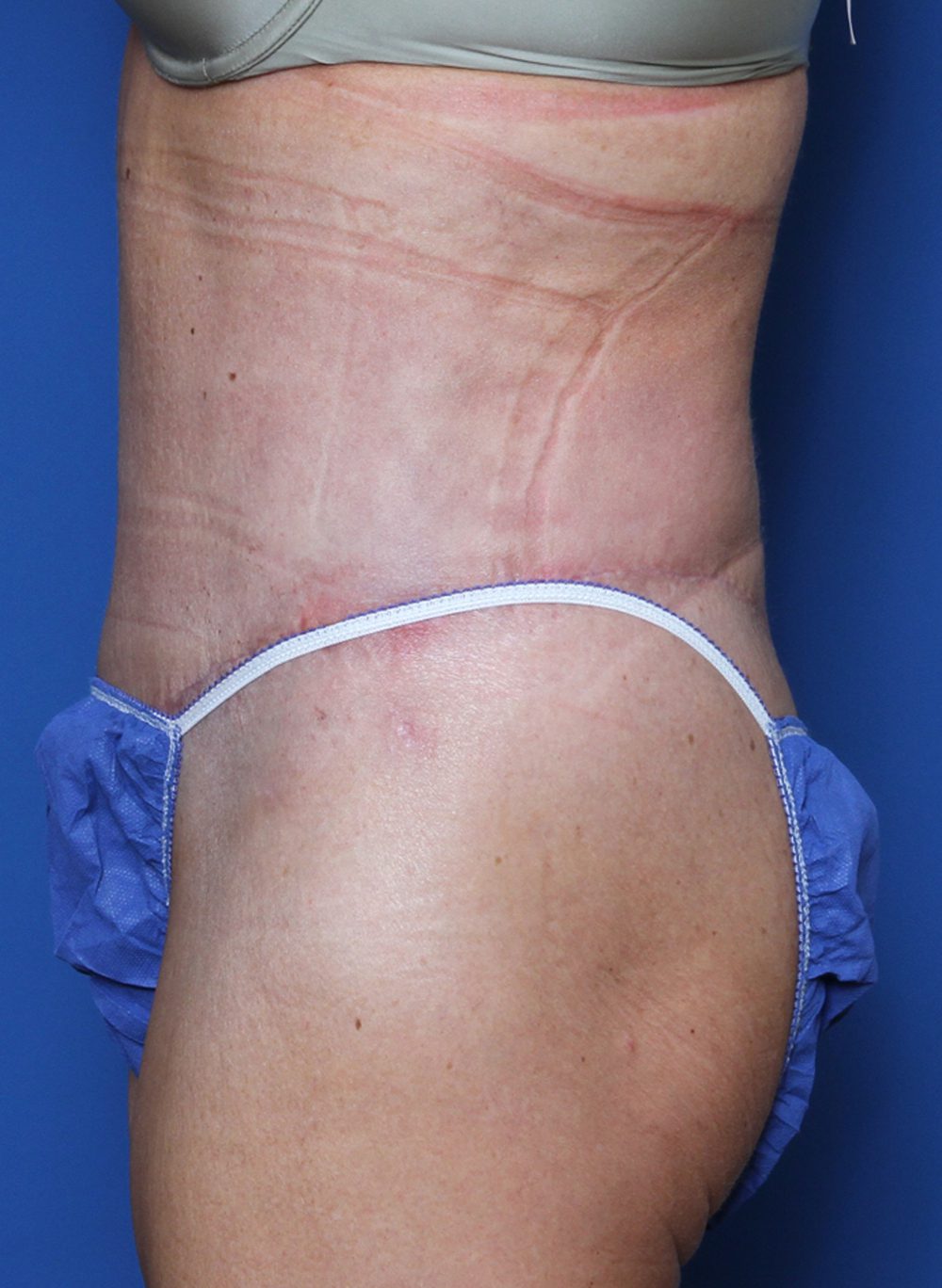 Belt Lipectomy Patient Photo - Case 144 - after view-1
