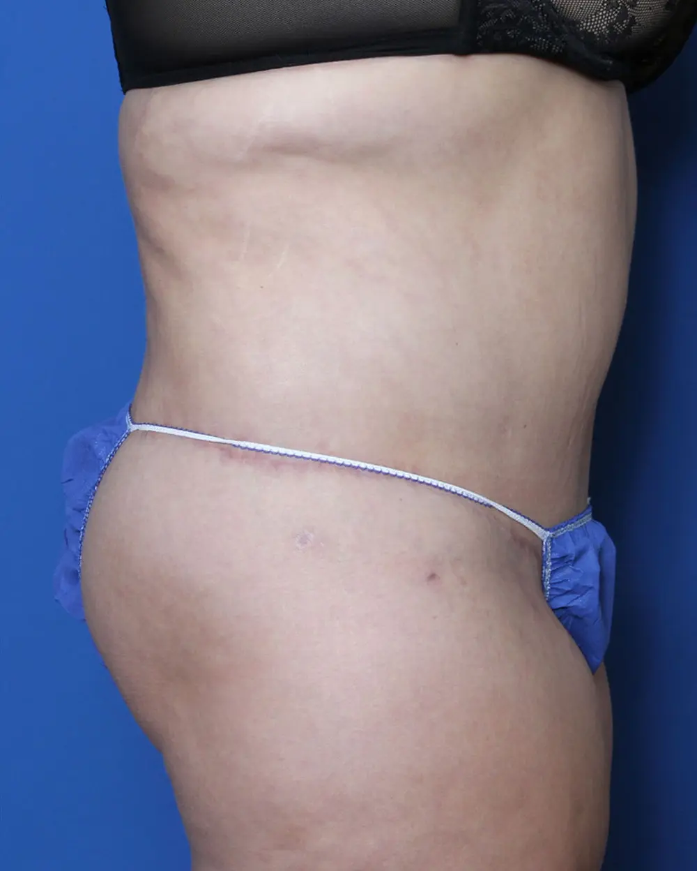 Belt Lipectomy Patient Photo - Case 146 - after view-2