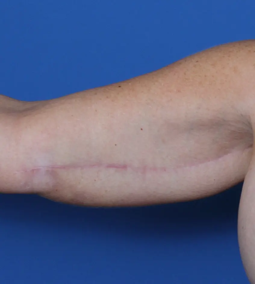 Arm Lift Patient Photo - Case 154 - after view-1