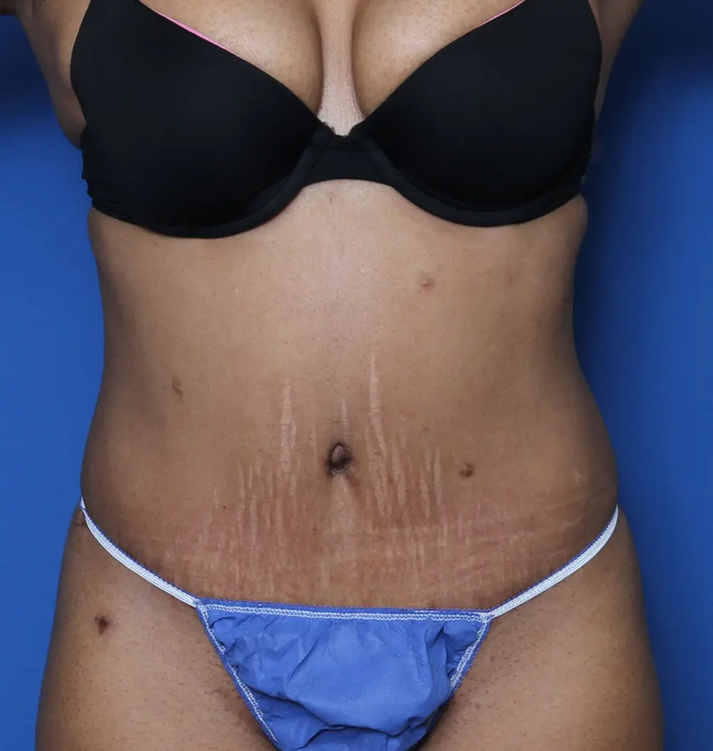 Tummy Tuck Patient Photo - Case 133 - after view