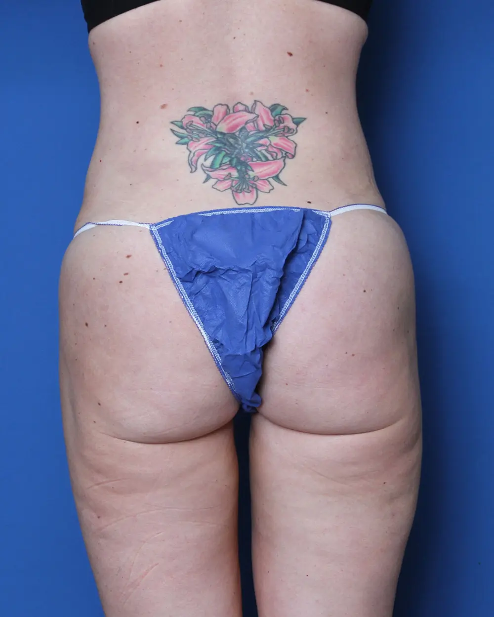 Liposuction Patient Photo - Case 156 - after view