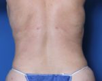 Liposuction - Case 160 - After