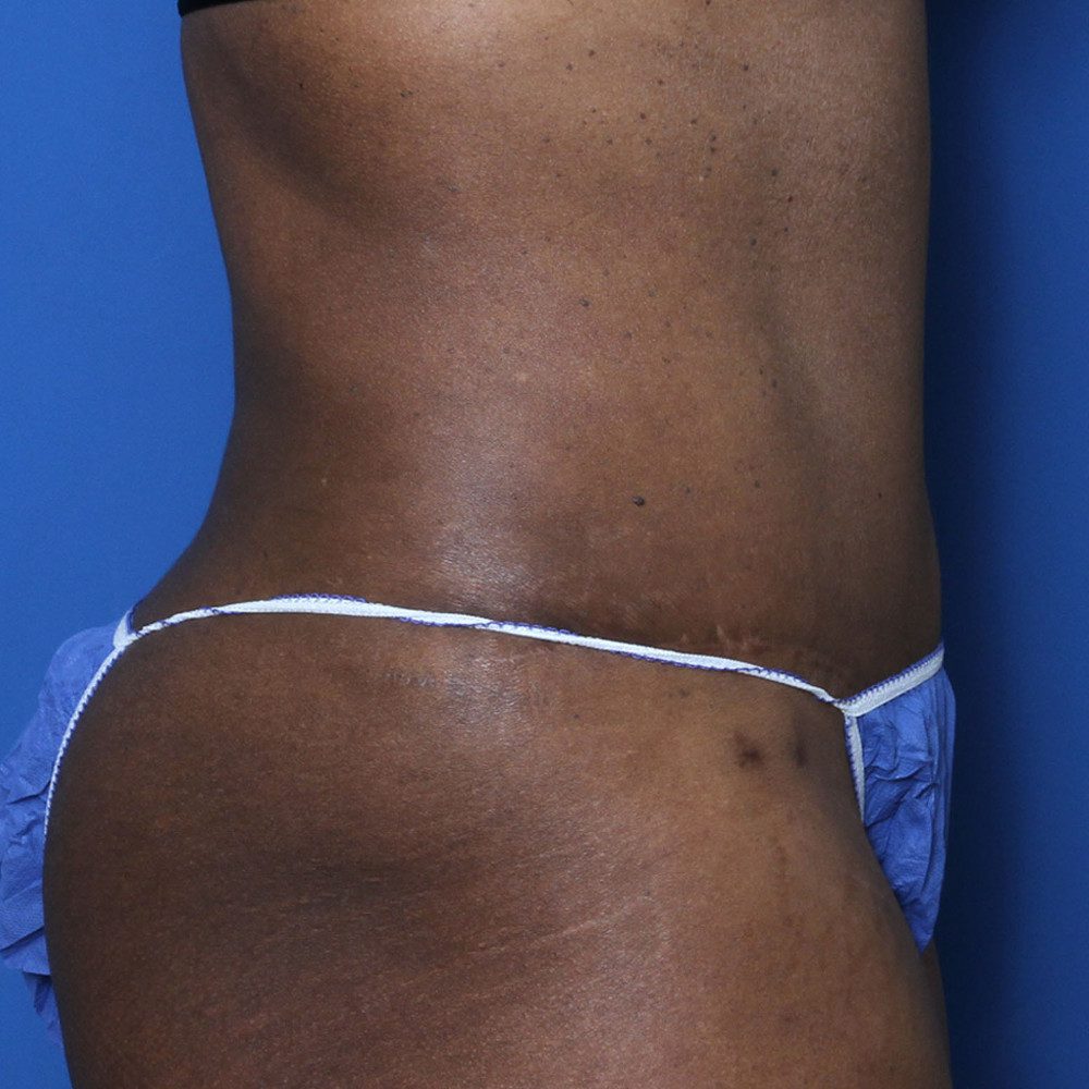 Tummy Tuck Patient Photo - Case 134 - after view-2