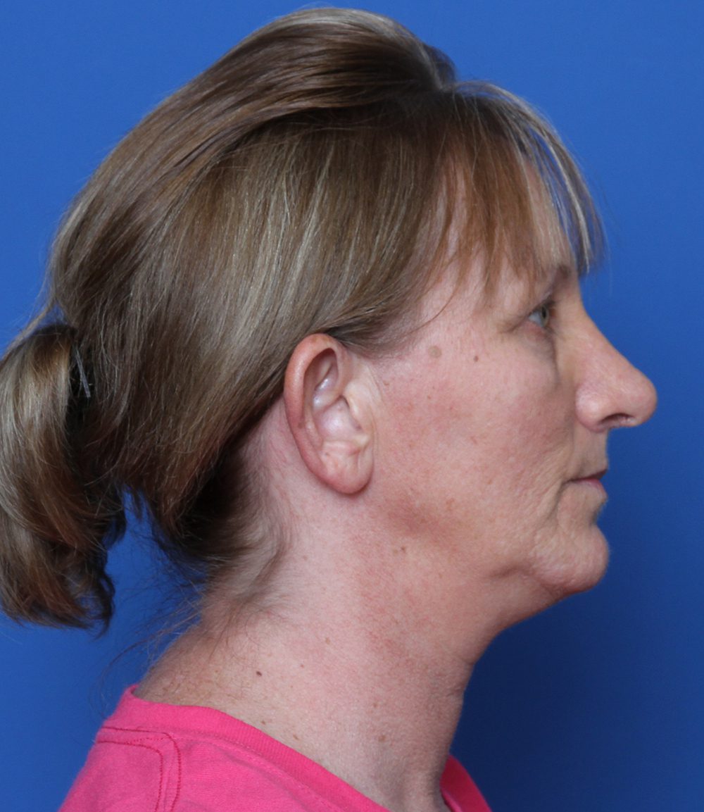 Rhinoplasty Patient Photo - Case 174 - after view-1