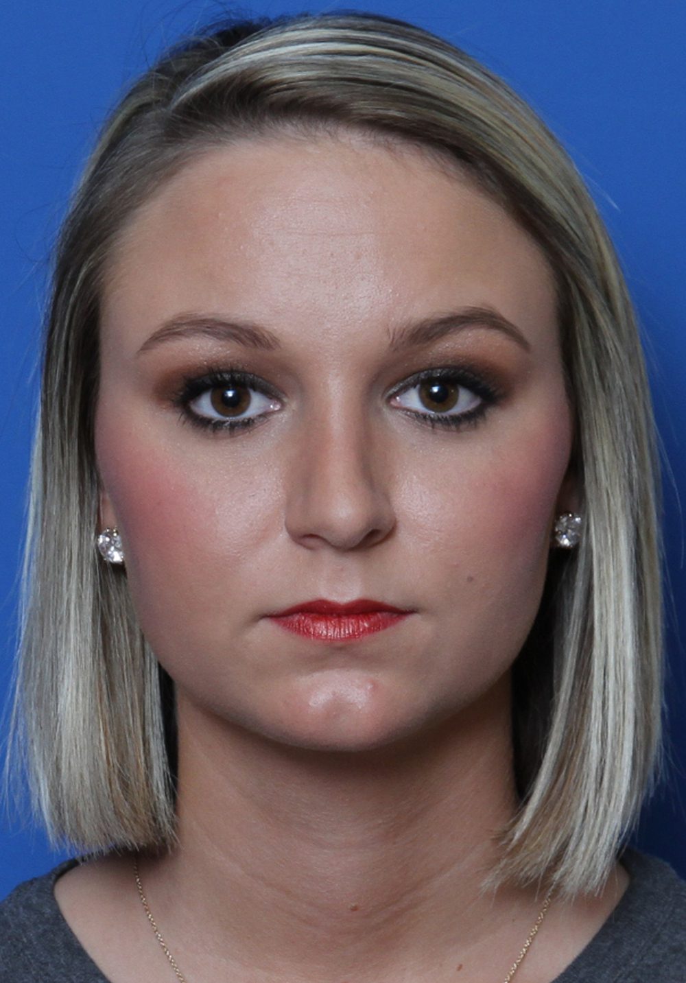Rhinoplasty Patient Photo - Case 175 - after view